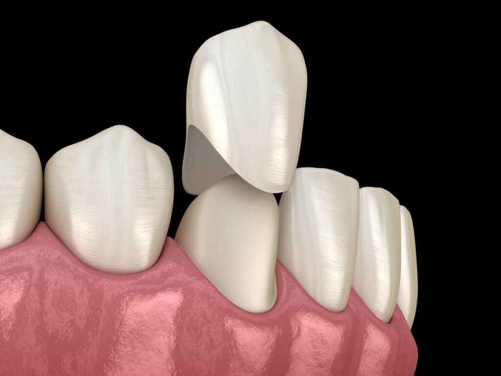 Graphic of Dental Crowns at Oak Hills Dentistry in Spring, TX