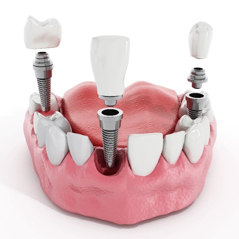 Graphic of dental implant crowns in Spring, TX