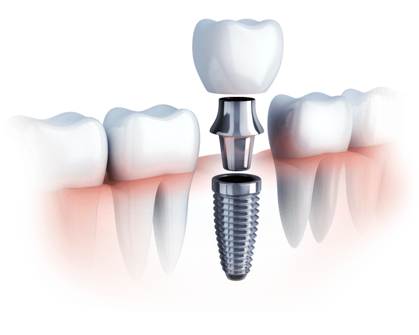 Animated image of a dental implant post and crown in Spring, TX