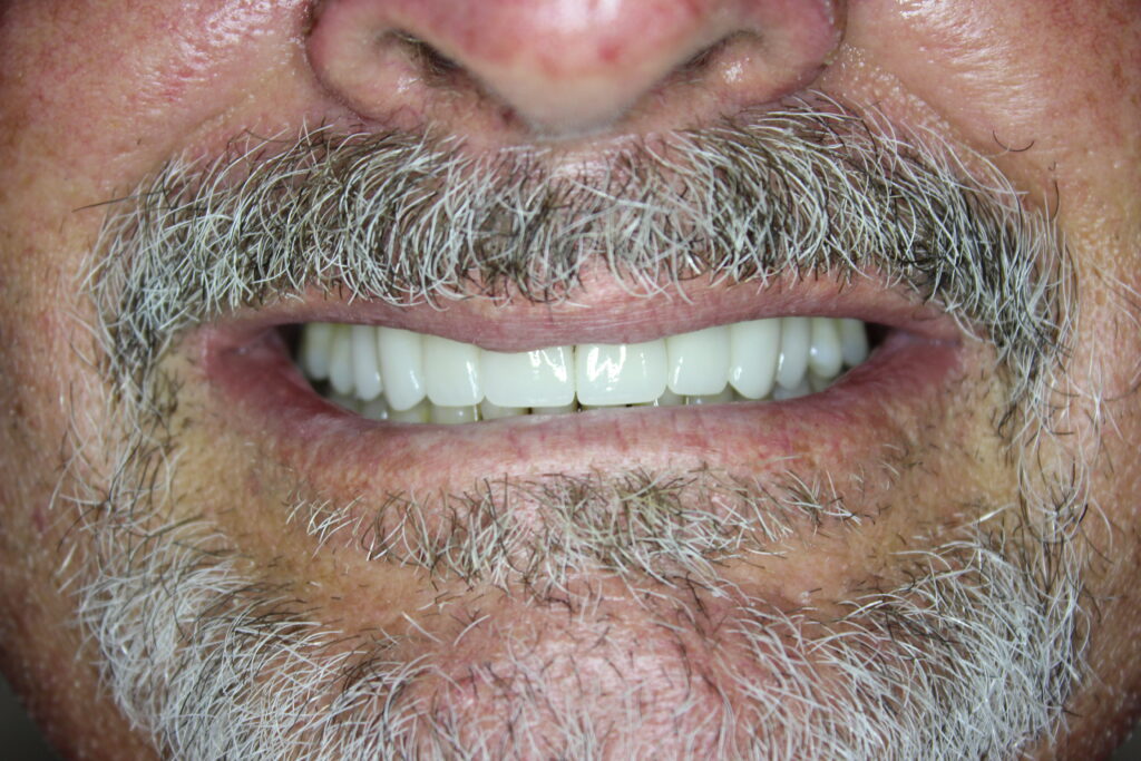Close up of mans mouth with perfect teeth after veneers in Spring, TX