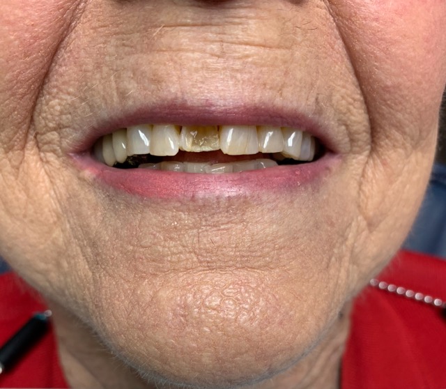 Older dental patient with a broken tooth in Spring TX before treatment
