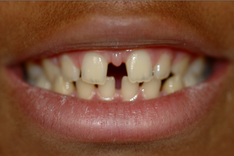 Close up photo of dental patient with gaps between teeth in Spring, TX