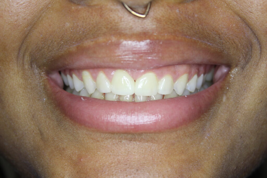 Close up photo of patient after orthodontics and veneers fixed gaps in her teeth in Spring, TX