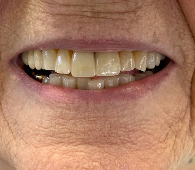 Patient smile after a color matched dental crowns repaired her damaged tooth in Spring, TX