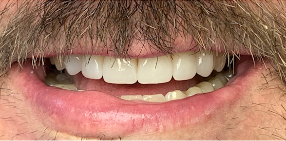 Patient new teeth and perfect smile after full mouth reconstruction by Dr. Smith in Spring, TX