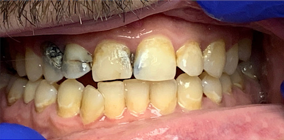 Patient with severely damaged and decayed teeth before full mouth reconstruction in Spring, TX